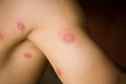 ringworm